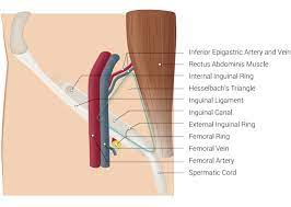 Kiejtés hesselbach triangle1 hang kiejtése, többet a hesselbach triangle. Figure Inguinal Region Inferior Epigastric Artery Statpearls Ncbi Bookshelf
