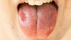 Image result for papillomavirus tongue)