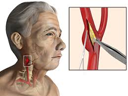 Diabetes.diabetes lowers your ability to process fats efficiently, placing you at greater risk of high blood pressure and atherosclerosis. Carotid Endarterectomy Surgery Sydney Cad Treatment Sydney