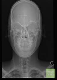 Ventriculoperitoneal Shunt Disruption Radiology Case Radiopaedia Org