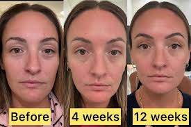 Neo-filler results after 12 weeks