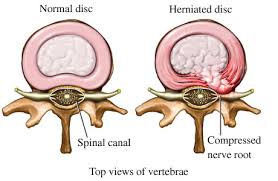 EMG Testing For Herniated Discs- EMG Test PAdoctor_step