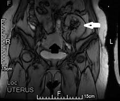 Slightly more implants which happen to be deeper and more mild adhesions. Endometrial Cancer In A Renal Transplant Recipient A Case Report
