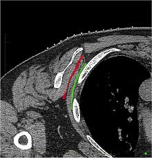 Image result for Scapulothoracic Injection