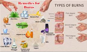 Burns First Aid At Home Diy Home Remedies For Burns Second Degree Burn Treatment Homemade Medicines Oin Home Remedies For Burns Burns Treatment Burn Remedy
