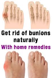 Get Rid Of Bunions Naturally With Home Remedies Jointpainrelief Get Rid Of Bunions Bunion Remedies Bunion