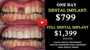 All On 6 Dental Implant Cost In Tijuana Mexico Save Up 75 Youtube Dental Implants Cost Dental Implants Dental
