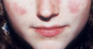 Picture Of Systemic Lupus Erythematosus 2 Discoid Lupus Erythematosus Systemic Autoimmune Disease Lupus