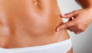 Ab wann wird ein geplanter ks gemacht? Der Kaiserschnitt Erklart Von Einer Physiotherapeutin
