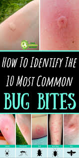 Bed Bug Bites That Look Like Mosquito Bites Pin On Health Tips