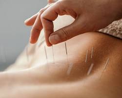 Image of Acupuncture: A photo of a person receiving acupuncture treatment, with needles at various points on their body
