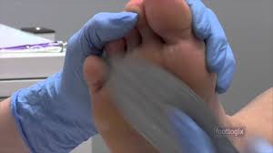 Place the bandage inside of your running shoes where the shoes rub against your foot. How To Remove Callus Foot Callus Remover Youtube