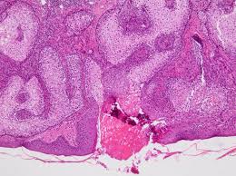 Muir Torre Syndrome Dermatology Advisor