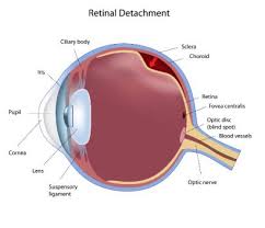 Jun 24, 2021 · x retinopathy of prematurity (rop) screening, an integral part of pediatric ophthalmology, can be time consuming and resource intensive. Don T Mess Around With Retinal Tears Better Vision Guide