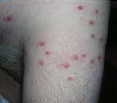 Image result for bedbugs bites