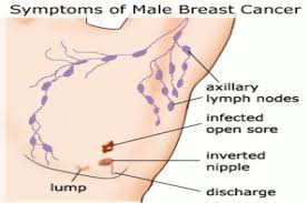 We see a single case in male after seeing around 100 to. Signs And Symptoms For Male Breast Cancer Health