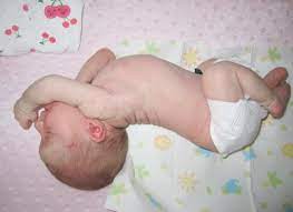 Baby Arching Back New Kids Center