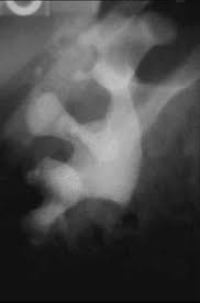 Image result for Nephrolithiasis Imaging