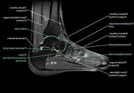 The presence of intramuscular edema (increased high t2/stir signal) on mri carries an extremely broad differential. Mri Ankle Anatomy Foot Anatomy Ankle Anatomy Anatomy