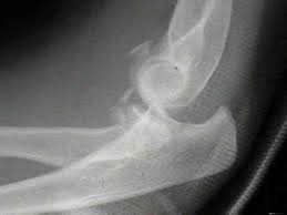 Image result for Radial Head Dislocation