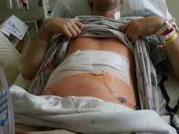 Maybe you would like to learn more about one of these? Liver Resection On Tuesday Here S The Incision Cancer