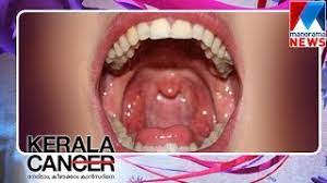 It typically starts in the cells that line your throat, and it's most common in people who smoke and drink. Dr V C Raveendren Speaks About Oral Cancer And Treatments Manorama News Youtube
