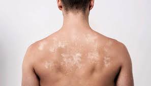 Información sobre verrugas malignas y contenido relacionado con verrugas malignas y lunares y pecas. Infecciones Cutaneas Moluscos Contagiosos Verrugas Micosis Dermatologos Fernandez Crehuet