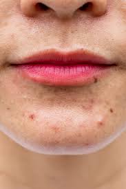How to get rid of pih. Best Post Inflammatory Hyperpigmentation Pih Fading Treatments Vogue Singapore Skin Beauty