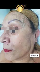 Radiofrequency (RF) is a non-invasive cosmetic treatment that uses  electromagnetic waves to heat the deeper layers of the skin. This  controlled heating stimulates collagen production, which is a key ...
