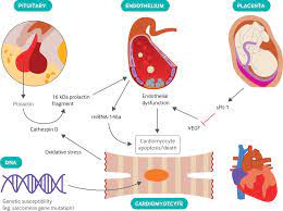 • definition:myocarditis is an inflammatory disease of cardiac muscle. Peripartum Cardiomyopathy The Bmj