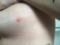 Entzundung An Brust 19 Ssw Forum Schwangerschaft Urbia De