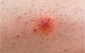 Ingrown hairs will generally go away without treatment. What Is An Ingrown Hair Treatment Tips Tricks