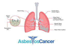 Pleural Mesothelioma Symptoms To Look Out For Mesothelioma Treatment Options Cancer