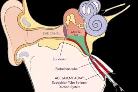 Image result for Eustachian Tube Dysfunction