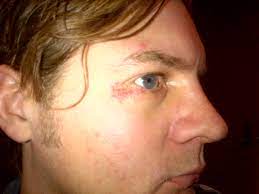 Patch Dry Red Skin Under Eye Apalonshed