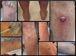 The condition is easily treatable. Eruptive Squamous Cell Carcinomas In Metastatic Melanoma An Unintended Consequence Of Immunotherapy Jaad Case Reports