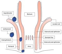 Image result for Ischiorectal Abscess