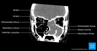 Gross anatomy the nasal cavity is formed by 1: Schwannoma Of The Nasal Cavity Clinical Case Diagnosis Kenhub