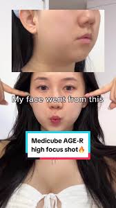 Hifu Double Chin Before and After Singapore