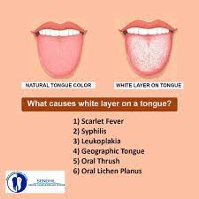 We did not find results for: White Colored Tongue White Layers Geographic Tongue Tongue