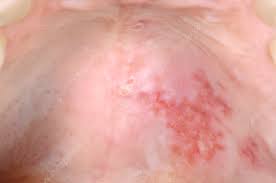 Image result for Oral herpes roof of mouth