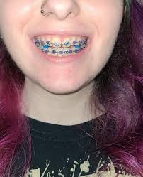 The smaller ones aren't too bad, they wear down pretty quickly to a shape that is easier to eat with. Got Braces Today Plus Bite Blocks Braces