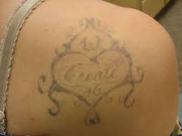 393 denbigh blvd, newport news va 23608 the best foundation is glowing, healthy skin for every occasion, for everyone. Atlantic Laser Tattoo Removal Tattoo Cover Ups And Tattoo Removal
