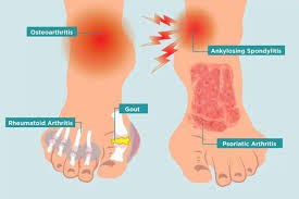 Pin By Anja On Health In 2020 Psoriatic Arthritis Rheumatoid Arthritis