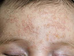 Image result for white scabs on the head in children