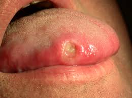 Image result for mouth ulcer on tongue)