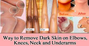 Maybe you would like to learn more about one of these? Easy Way To Remove Dark Skin On Elbows Knees Neck And Underarms Latest Health And Beauty Tips