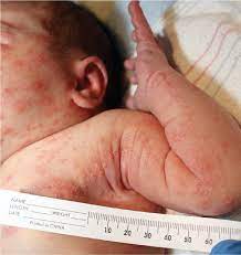 Newborns tend to have more hair follicles than adults and the rash doesn't show up on the palms or soles. Linear Lesions In A Neonate Photo Quiz American Family Physician