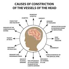 A cerebral stroke is an acute neurologic injury involving the cerebral hemispheres. Cerebral Stroke Stock Illustrations 949 Cerebral Stroke Stock Illustrations Vectors Clipart Dreamstime