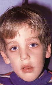 If I started mouth breathing at 15, will it change my facial features?